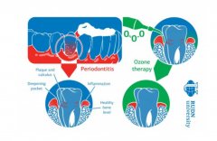 RUDN 大學牙醫(yī)建議采用基于臭氧的綜合抗炎療法